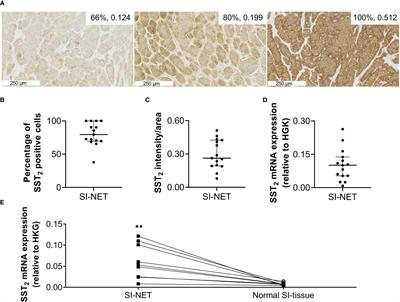 Epigenetic regulation of SST2 expression in small intestinal neuroendocrine tumors